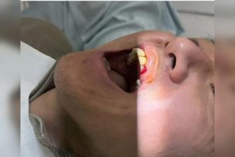 高迪嘴部受伤缝九针：全力治疗恢复 不想错过踢申花